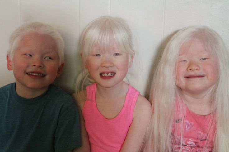Albinism in Asia: An Underrepresented Topic